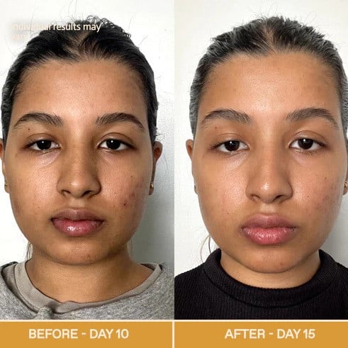 Red Light Therapy Before and After: Does It Really Work? 15 Red Light Therapy Before and After: Does It Really Work?