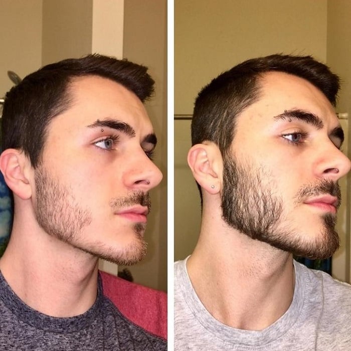 Minoxidil Before and After: Real Results and Photos