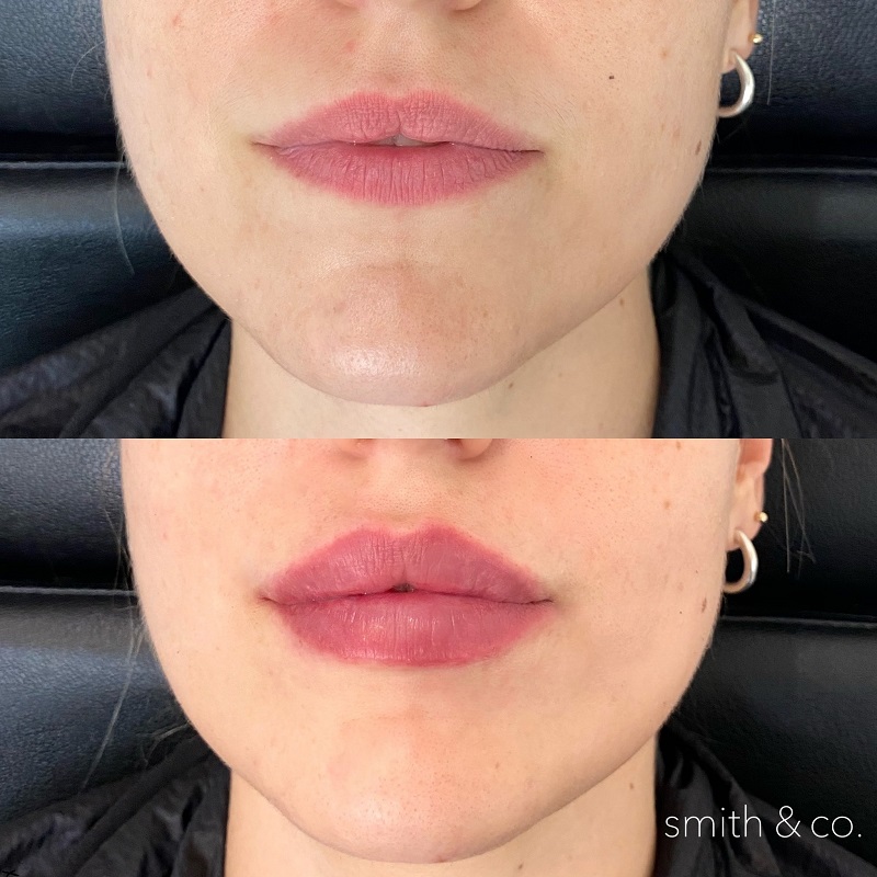 Lip Lift Before and After: Dramatic Results and Recovery Process