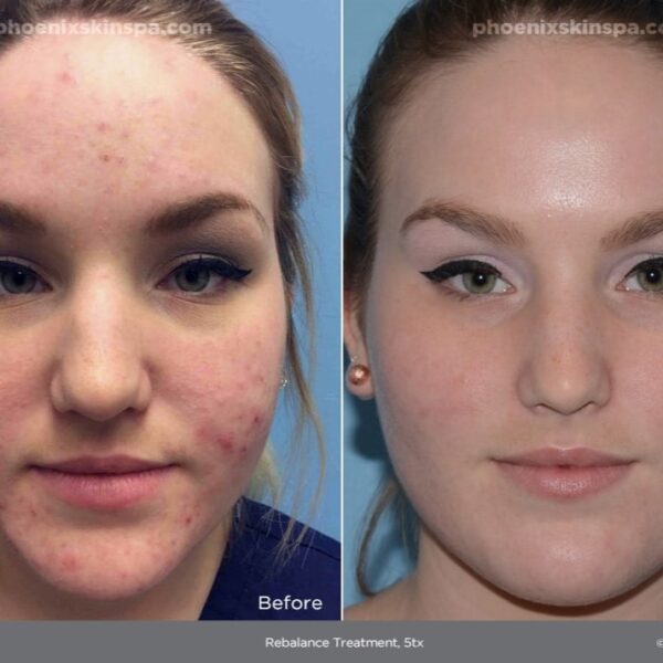 Red Light Therapy Before and After Does It Really Work? Must Read