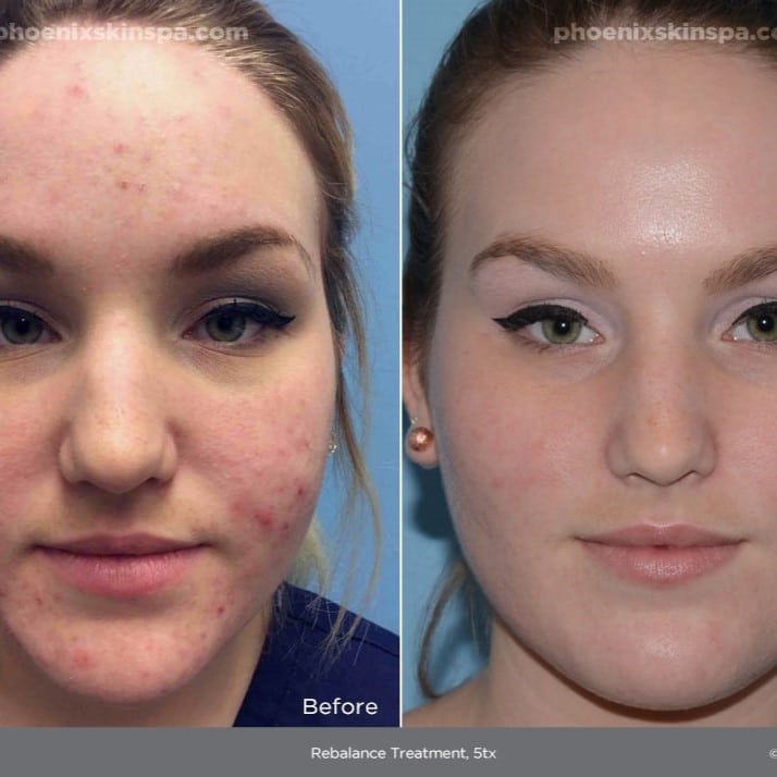 Red Light Therapy Before and After: Does It Really Work? 16 Red Light Therapy Before and After: Does It Really Work?