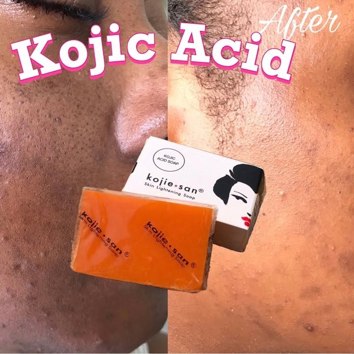 Kojic Acid Soap Before and After: Does It Really Lighten Skin?