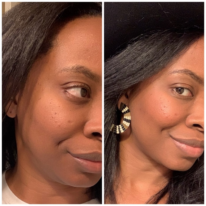 Gua Sha Before and After: Benefits and Results 16 Gua Sha Before and After: Benefits and Results