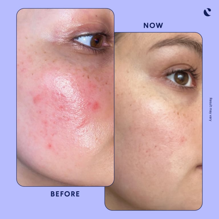 Tretinoin Before and After: A Comprehensive Analysis of its Effectiveness on Skin