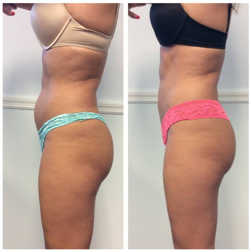 Coolsculpting Before and After: Results, Side Effects, and What to Expect 16 Coolsculpting Before and After: Results, Side Effects, and What to Expect