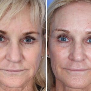 Sculptra Before and After: Transforming Your Appearance with Long