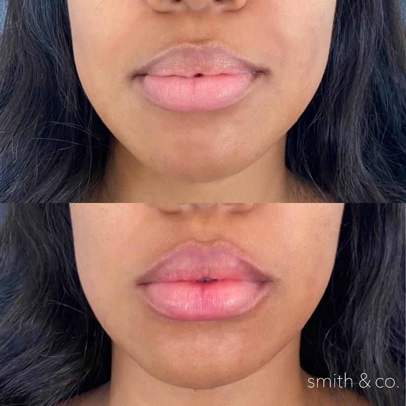 Lip Lift Before and After: Dramatic Results and Recovery Process