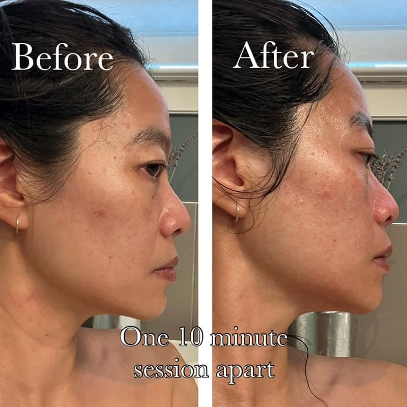 Gua Sha Before and After: Benefits and Results 17 Gua Sha Before and After: Benefits and Results