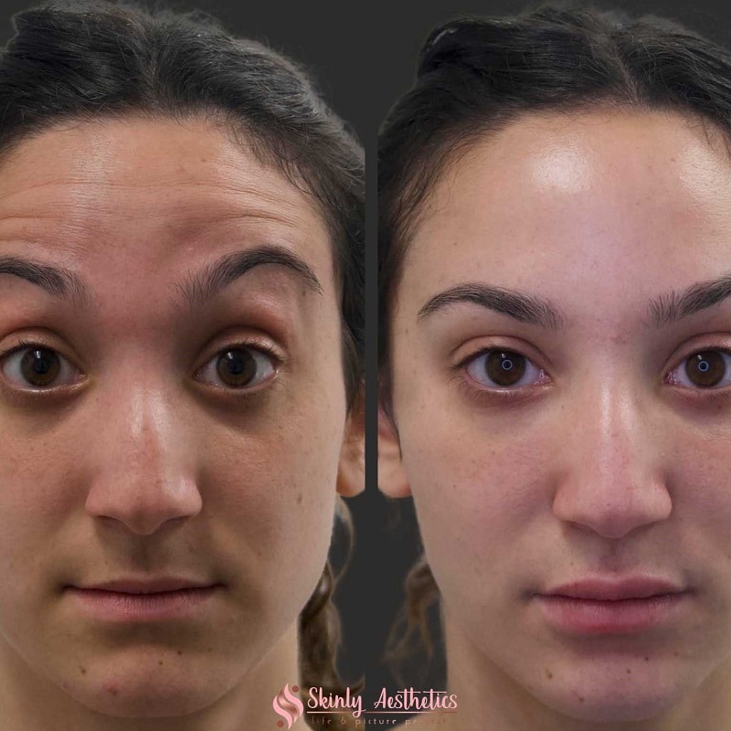 Botox Before and After: Dramatic Results and What to Expect