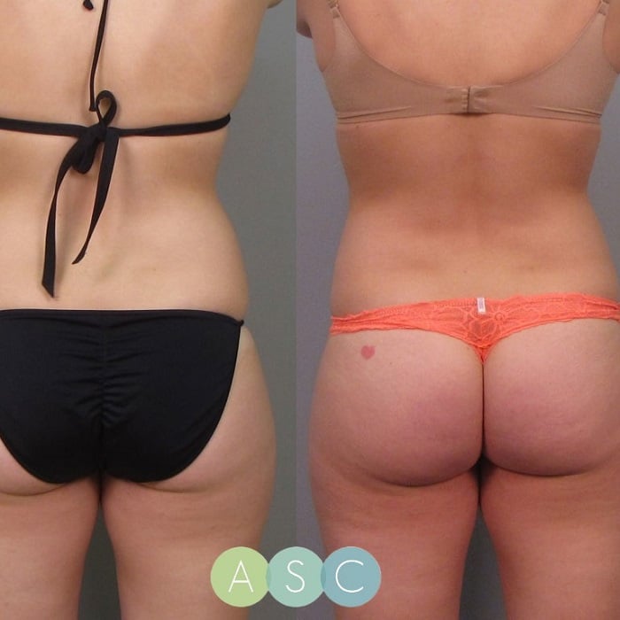 Coolsculpting Before and After: Results, Side Effects, and What to Expect 17 Coolsculpting Before and After: Results, Side Effects, and What to Expect