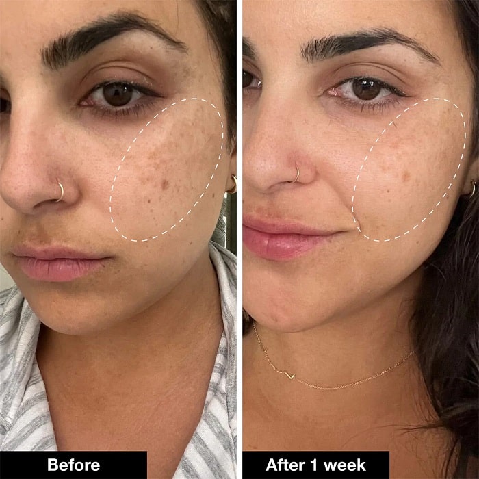 Retinol Before and After: Transform Your Skin with These Results