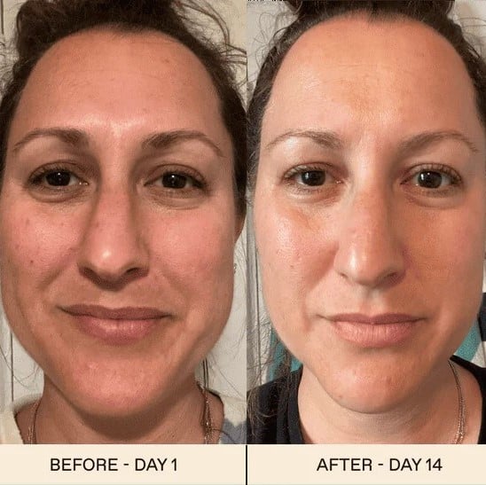 Red Light Therapy Before and After: Does It Really Work? 17 Red Light Therapy Before and After: Does It Really Work?