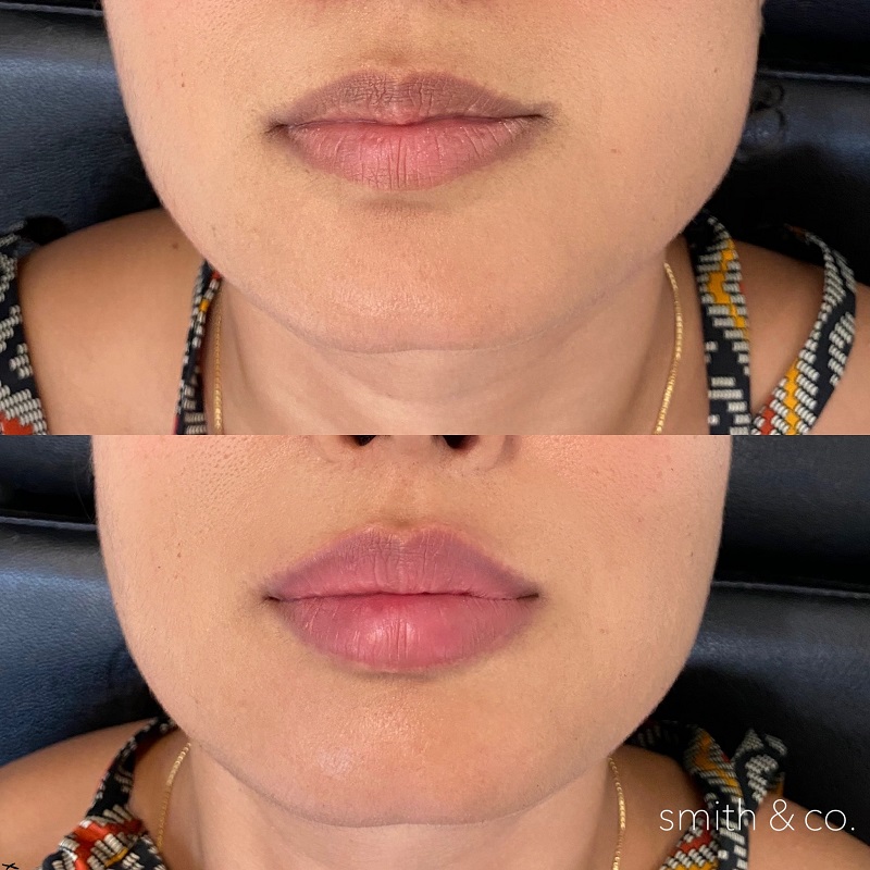 Lip Lift Before and After: Dramatic Results and Recovery Process