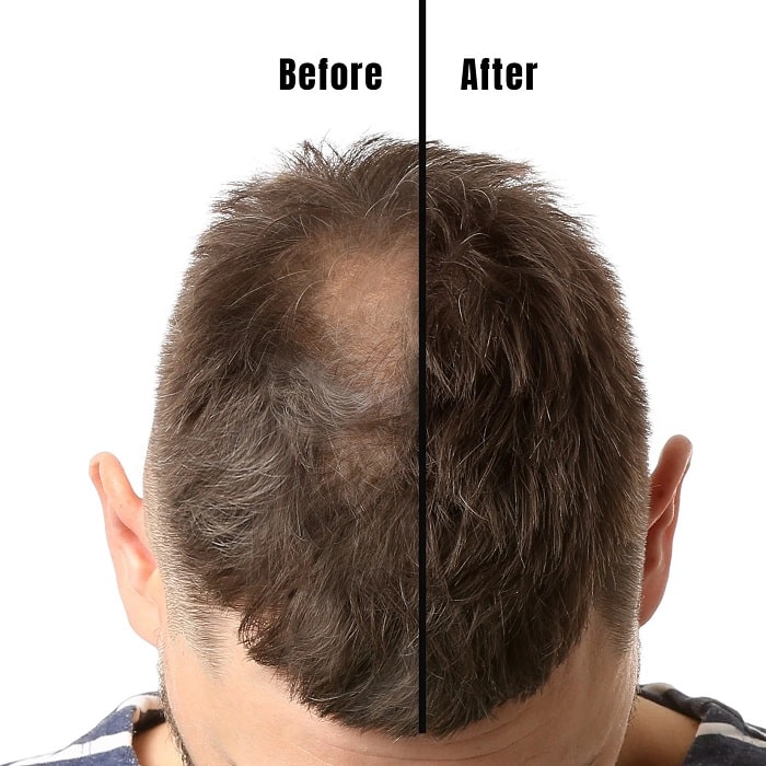 Minoxidil Before and After: Real Results and Photos