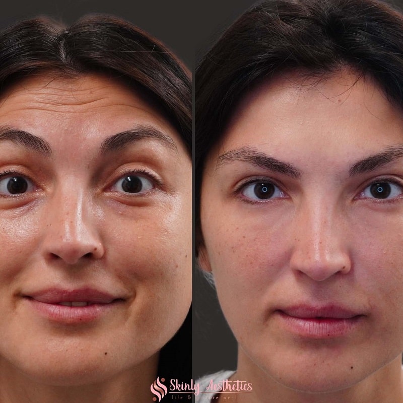 Botox Before and After: Dramatic Results and What to Expect