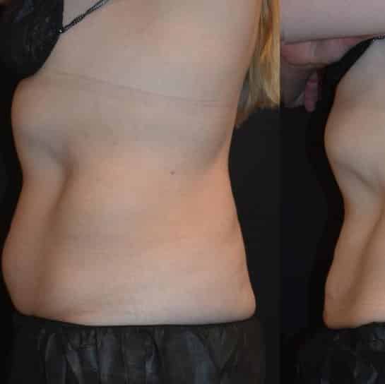 Coolsculpting Before and After: Results, Side Effects, and What to Expect 18 Coolsculpting Before and After: Results, Side Effects, and What to Expect