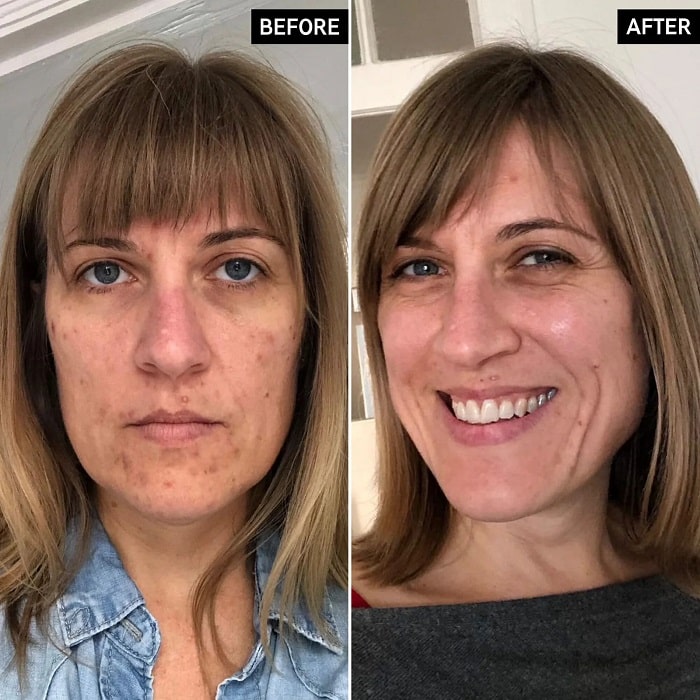 Retinol Before and After: Transform Your Skin with These Results 18 Retinol Before and After: Transform Your Skin with These Results