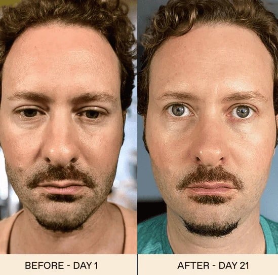 Red Light Therapy Before and After: Does It Really Work? 18 Red Light Therapy Before and After: Does It Really Work?