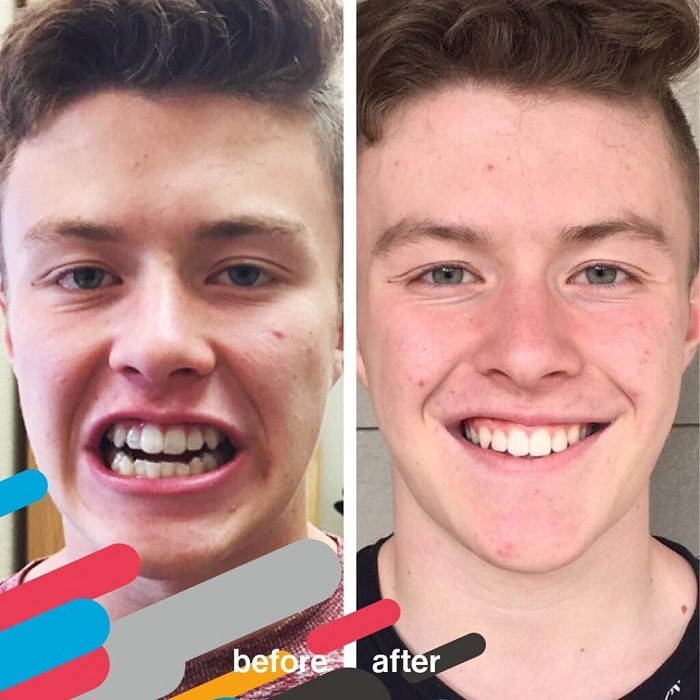 Invisalign Before and After: Transforming Your Smile with Clear Aligners