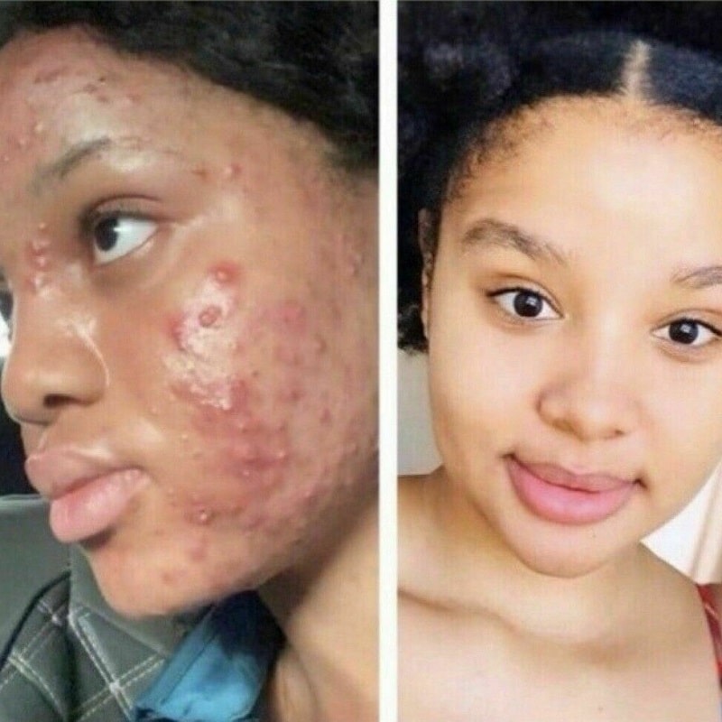 Kojic Acid Soap Before and After: Does It Really Lighten Skin? 19 Kojic Acid Soap Before and After: Does It Really Lighten Skin?