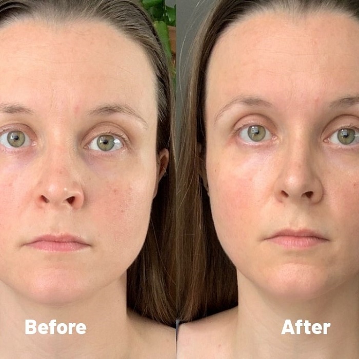 Gua Sha Before and After: Benefits and Results 19 Gua Sha Before and After: Benefits and Results