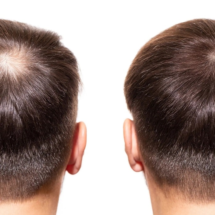 Minoxidil Before and After: Real Results and Photos