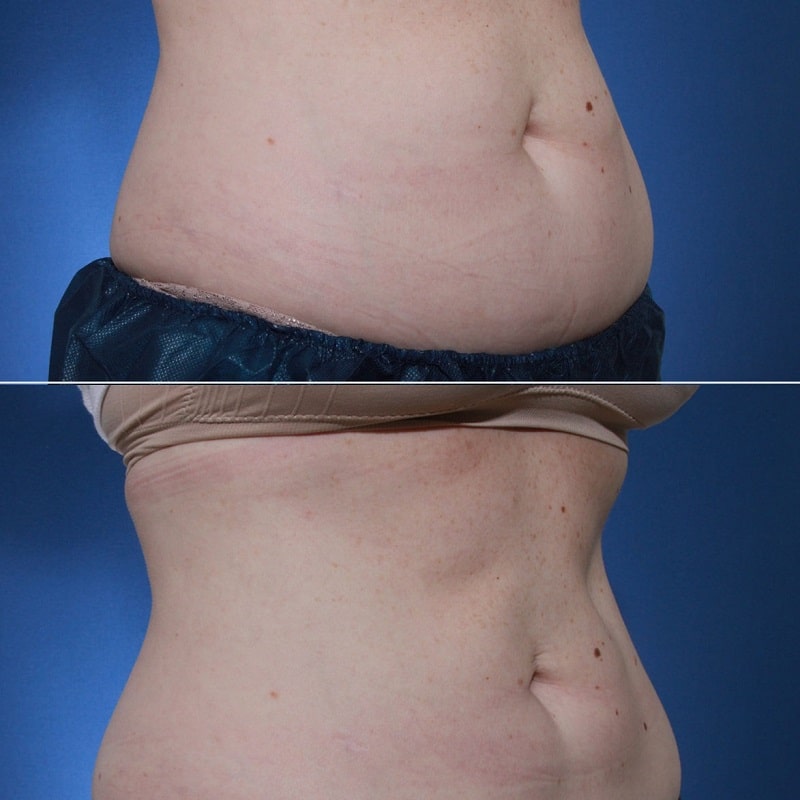 Coolsculpting Before and After: Results, Side Effects, and What to Expect 19 Coolsculpting Before and After: Results, Side Effects, and What to Expect