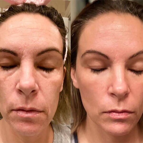 Red Light Therapy Before and After Does It Really Work? Must Read