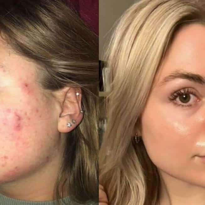 Tretinoin Before and After: A Comprehensive Analysis of its Effectiveness on Skin