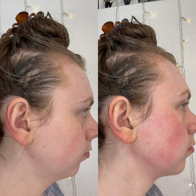 Gua Sha Before and After: Benefits and Results 20 Gua Sha Before and After: Benefits and Results