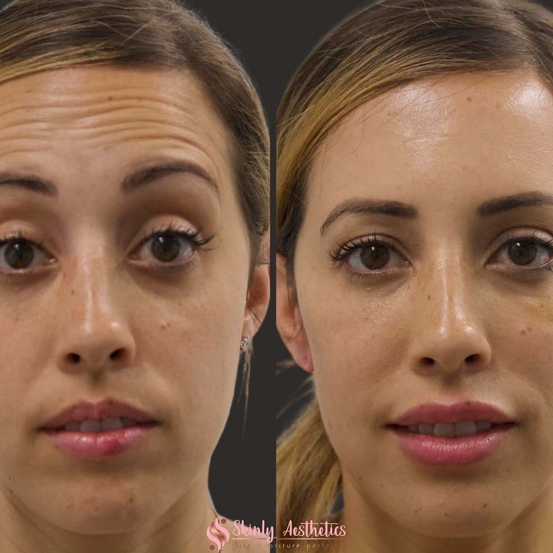 Botox Before and After: Dramatic Results and What to Expect