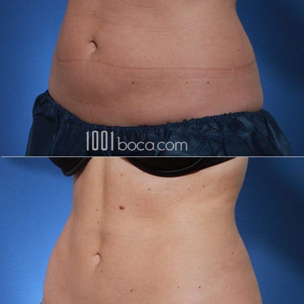 Coolsculpting Before and After: Results, Side Effects, and What to Expect