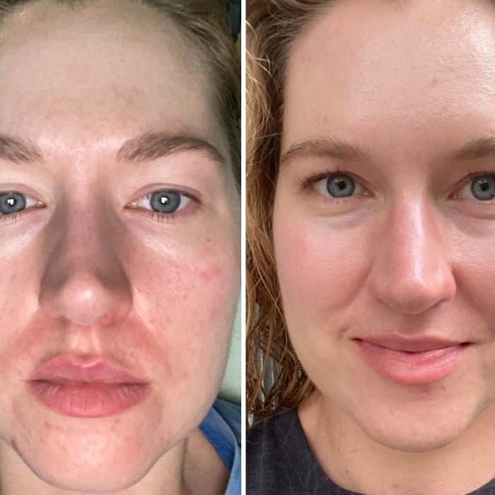 Retinol Before and After: Transform Your Skin with These Results