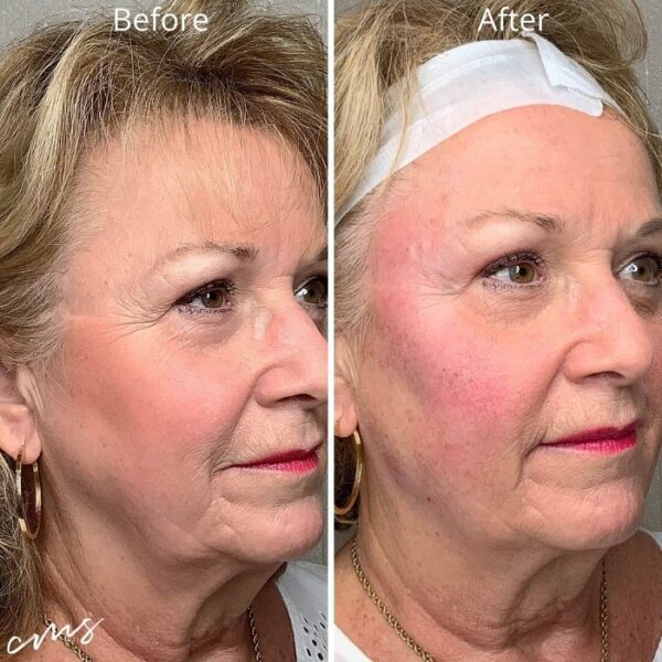 Sculptra Before and After Transforming Your Appearance with Long
