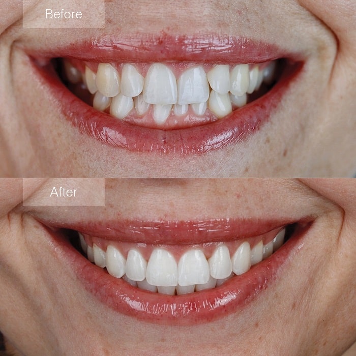 Invisalign Before and After: Transforming Your Smile with Clear Aligners