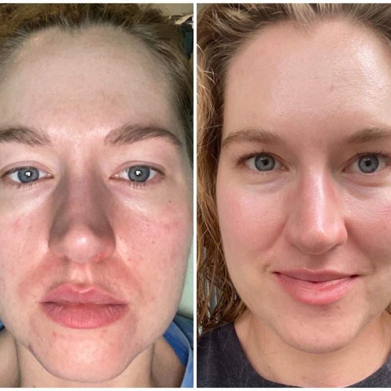 Tretinoin Before and After: A Comprehensive Analysis of its Effectiveness on Skin