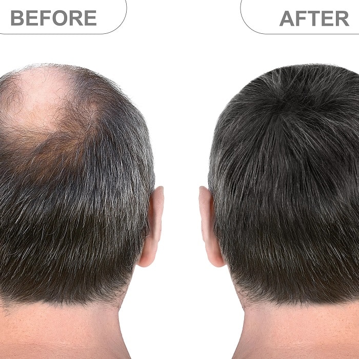 Minoxidil Before and After: Real Results and Photos