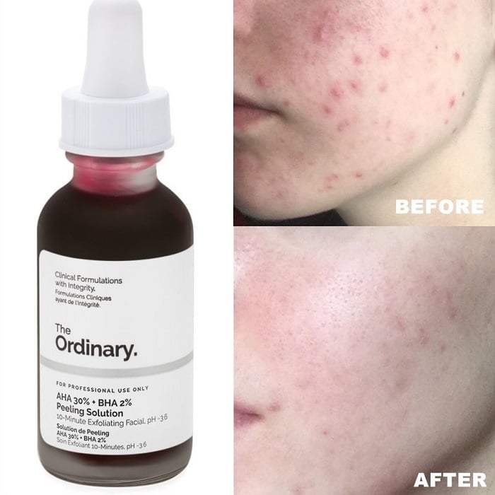 The Ordinary Peeling Solution Before and After: A Comprehensive Review