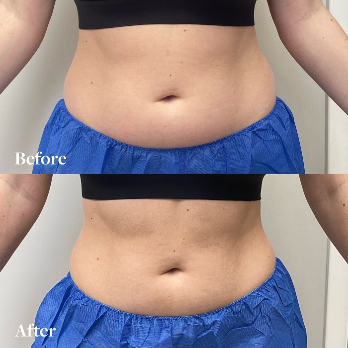 Coolsculpting Before and After: Results, Side Effects, and What to Expect 3 Coolsculpting Before and After: Results, Side Effects, and What to Expect