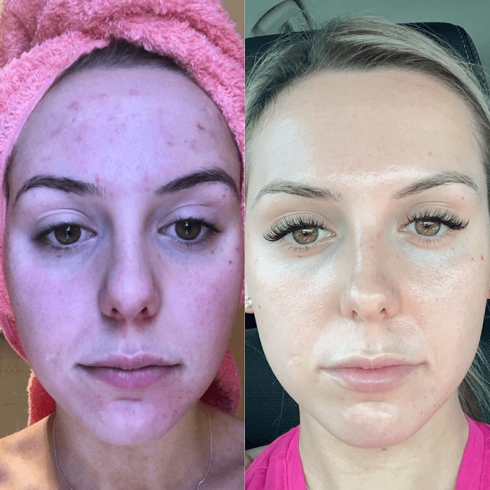 Red Light Therapy Before and After: Does It Really Work? 3 Red Light Therapy Before and After: Does It Really Work?