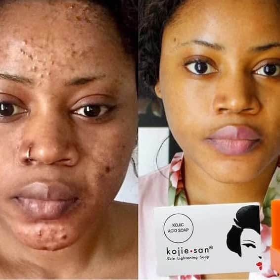 Kojic Acid Soap Before and After: Does It Really Lighten Skin? 21 Kojic Acid Soap Before and After: Does It Really Lighten Skin?