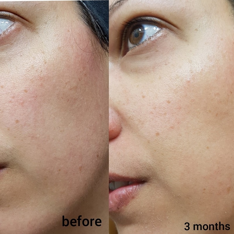 Tretinoin Before and After: A Comprehensive Analysis of its Effectiveness on Skin