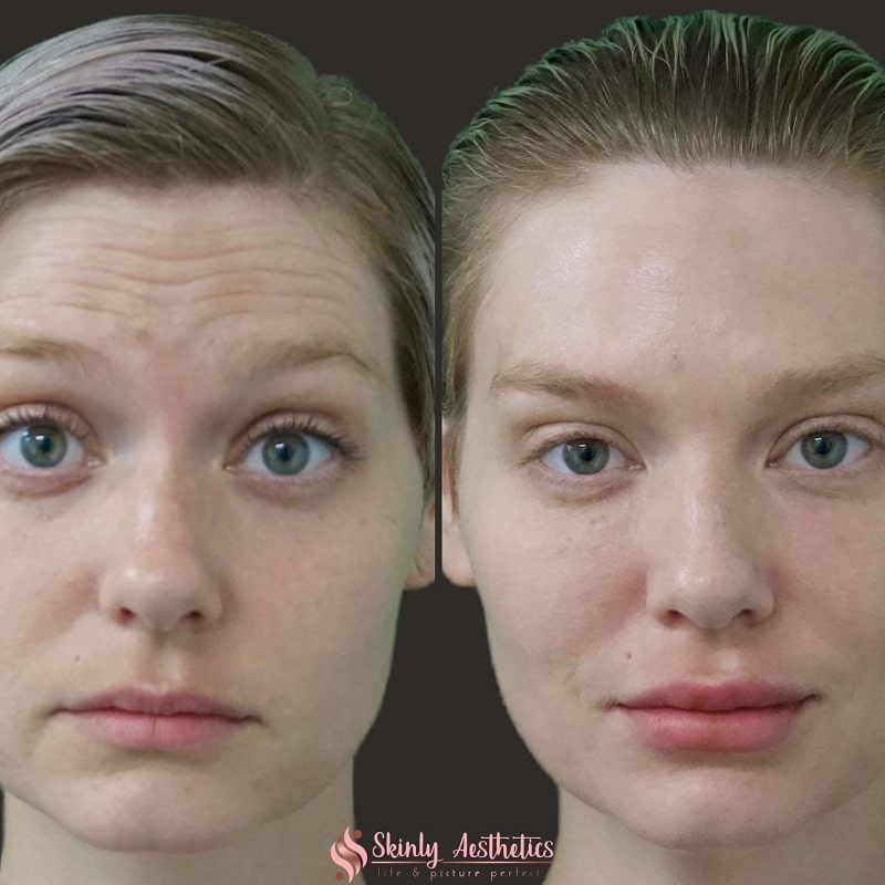 Botox Before and After: Dramatic Results and What to Expect