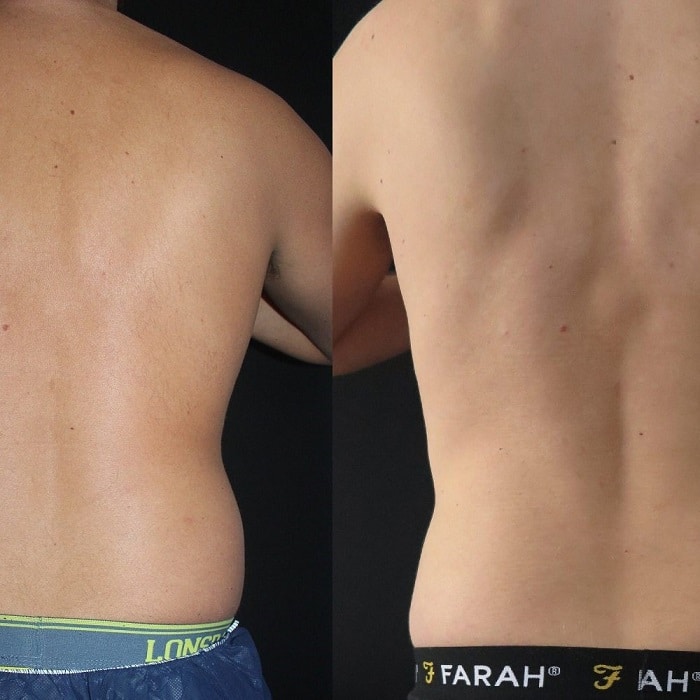Coolsculpting Before and After: Results, Side Effects, and What to Expect 21 Coolsculpting Before and After: Results, Side Effects, and What to Expect