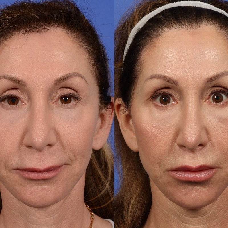Lip Lift Before and After: Dramatic Results and Recovery Process