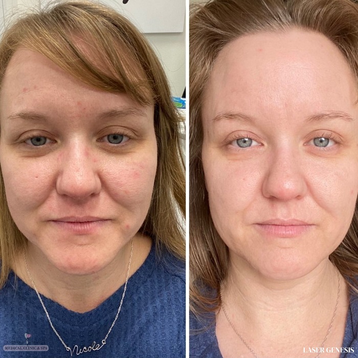 Gua Sha Before and After: Benefits and Results 22 Gua Sha Before and After: Benefits and Results