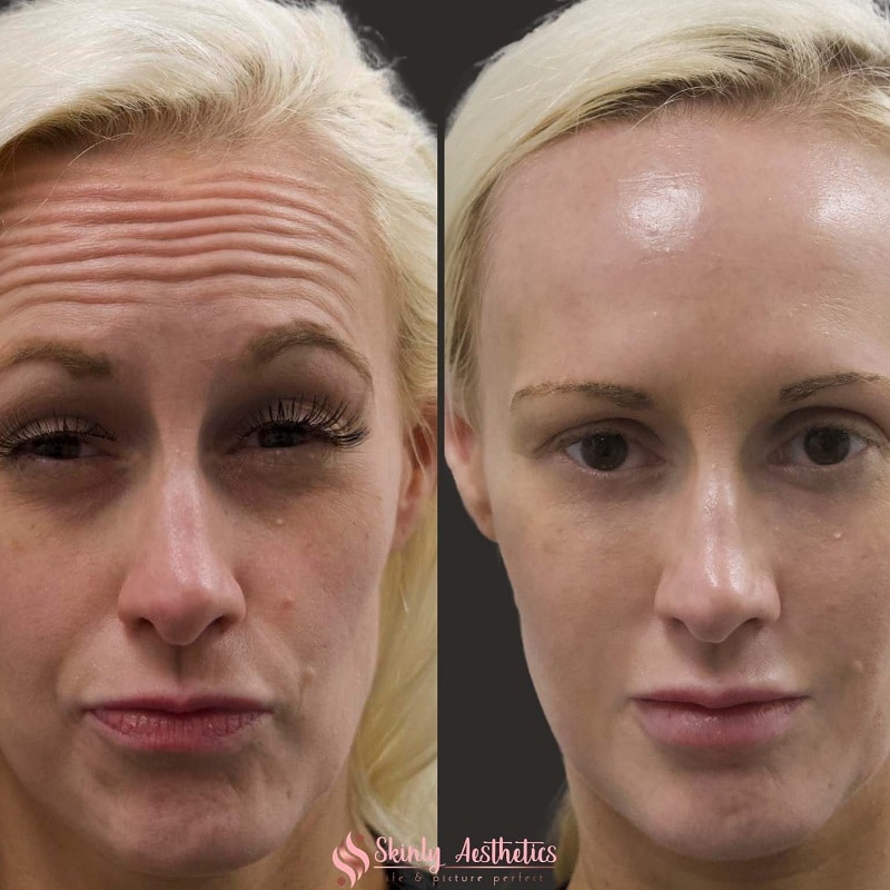 Botox Before and After: Dramatic Results and What to Expect