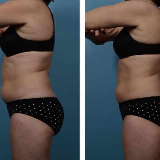 Coolsculpting Before and After: Results, Side Effects, and What to Expect 22 Coolsculpting Before and After: Results, Side Effects, and What to Expect