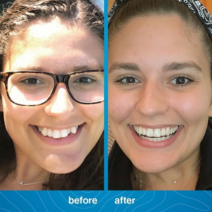 Invisalign Before and After: Transforming Your Smile with Clear Aligners