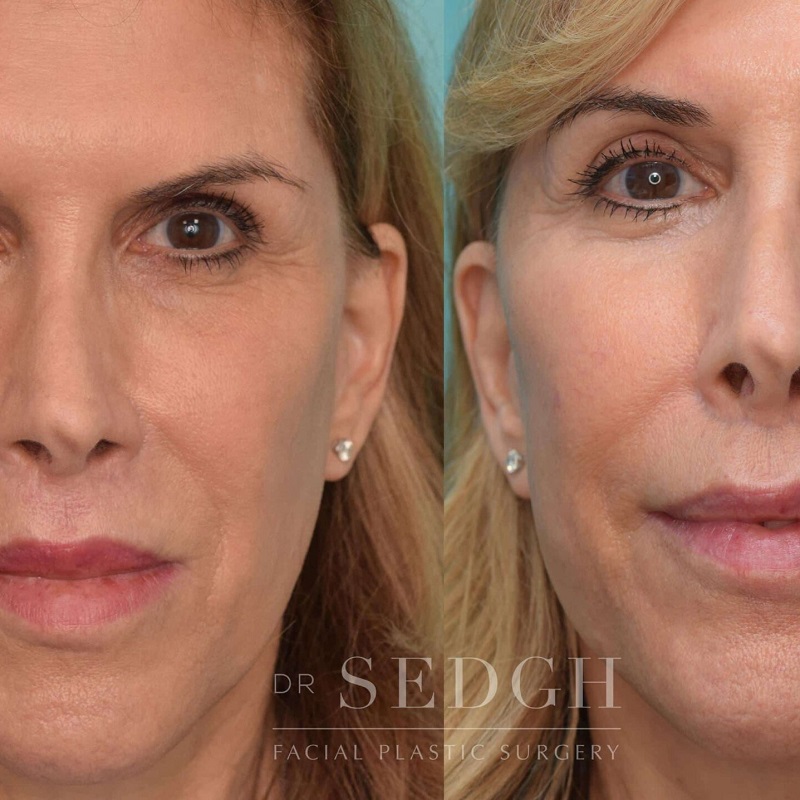 Lip Lift Before and After: Dramatic Results and Recovery Process